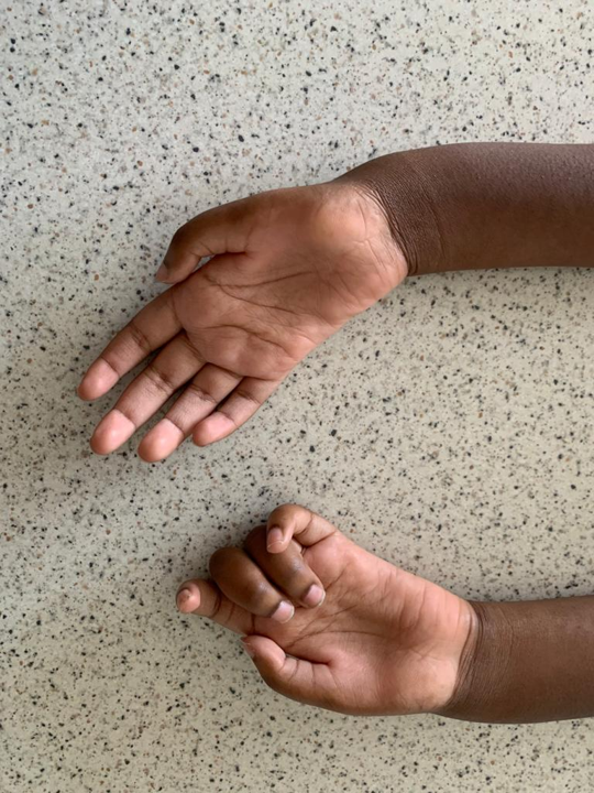 My left hand and right hand laid next to each other on the table. The fingers on my left hand are curled inwards and the fingers on my right hand are straight.